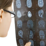 What Is the Link Between Car Accidents and Traumatic Brain Injuries (TBIs)?